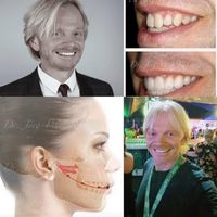 @porcelain.veneers